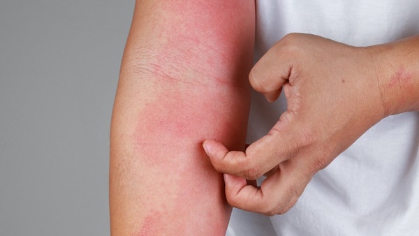 allergie cutanee et urticaire